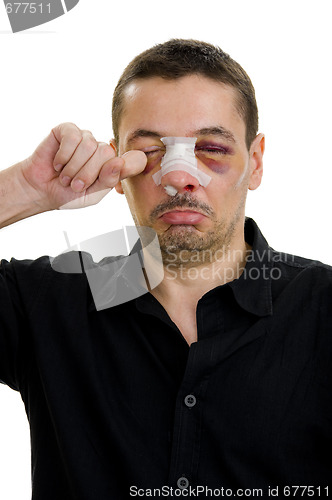 Image of broken nose post operation