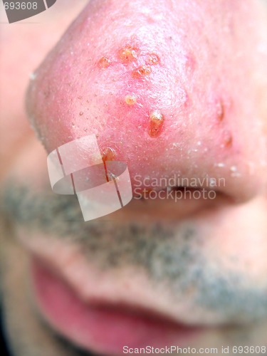 Image of Nose Cold Sore