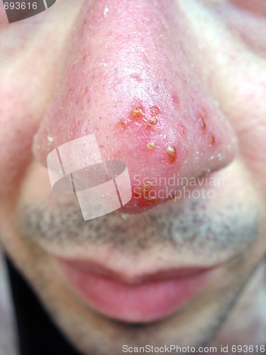 Image of Nose Cold Sore