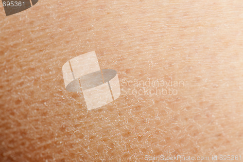 Image of Dry Skin