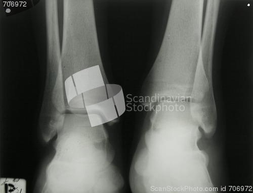 Image of X-ray photo of person's ankles