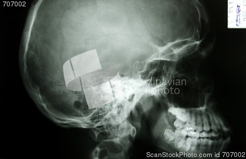Image of X-ray photo of a human skull