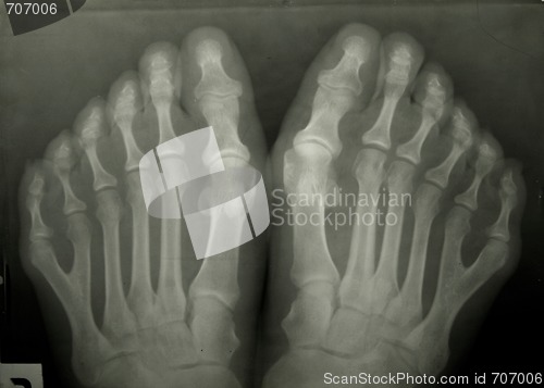 Image of X-ray photo of person's toes. 6 toes!