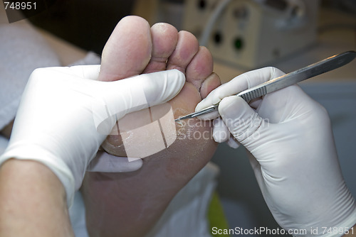 Image of Pedicure removing hard skin.