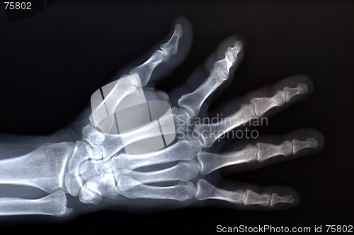 Image of x-ray of hand