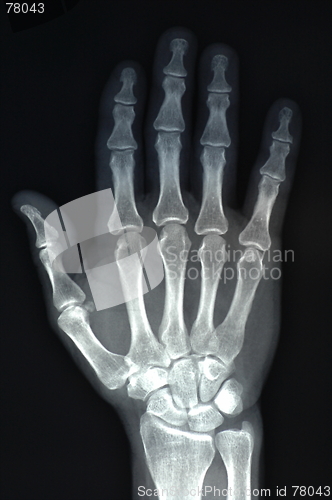 Image of hand x ray