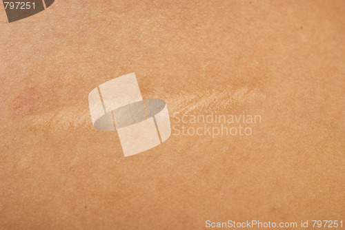 Image of scar on skin