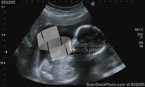 Image of Obstetric Ultrasonography