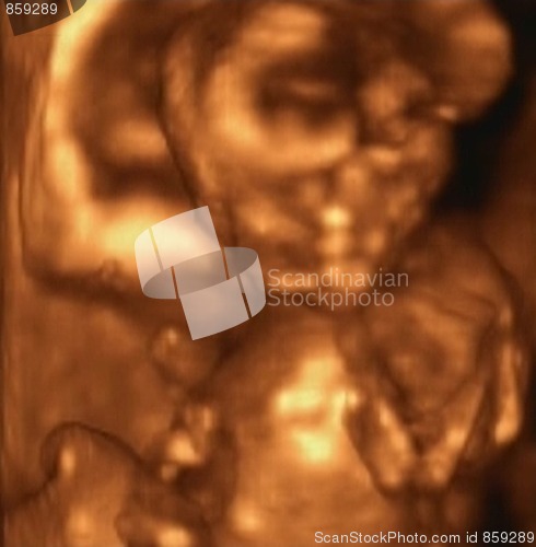 Image of Three Dimensional Ultrasound