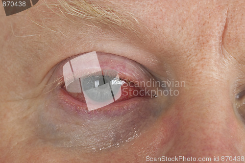 Image of Bloodshot eye