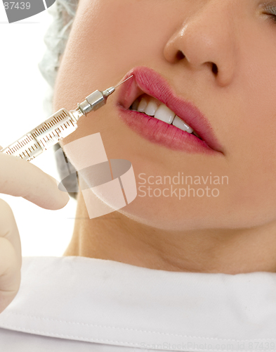 Image of Lip Augmentation