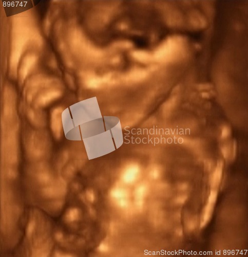 Image of Three Dimensional Ultrasound