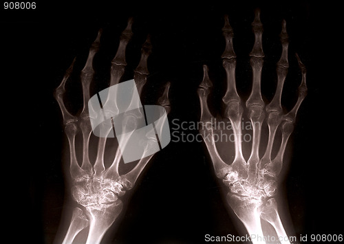 Image of Xray hands