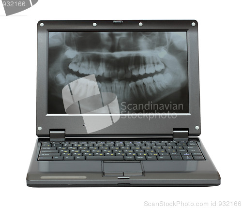 Image of small laptop with dental picture of jaw