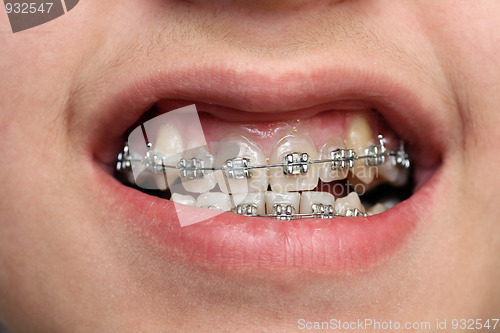 Image of children teeth with braces