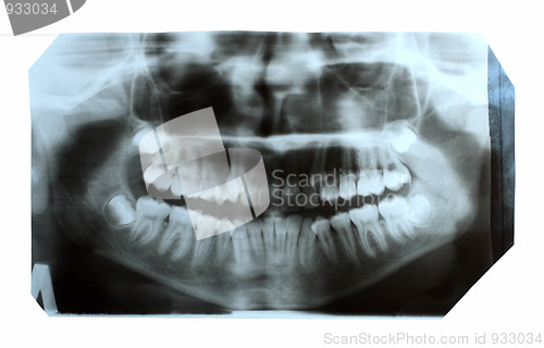 Image of dental x-ray picture of jaw