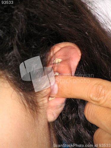 Image of Acupuncture