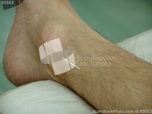 Image of Acupuncture