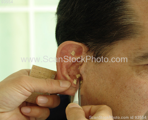 Image of Acupuncture