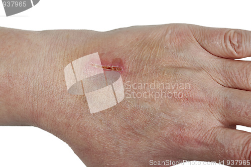 Image of Laceration