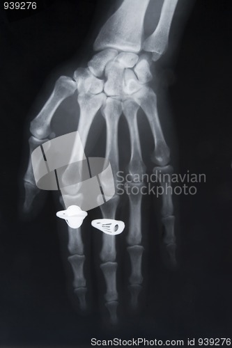 Image of x-ray image of hand with two rings