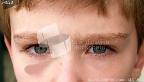 Image of boy with black eye