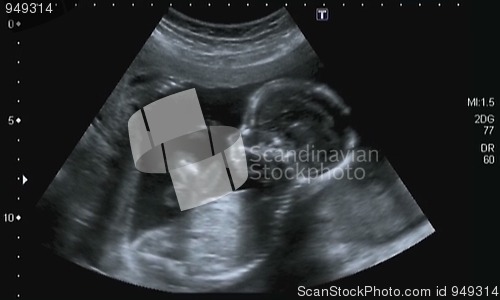 Image of Obstetric Ultrasonography