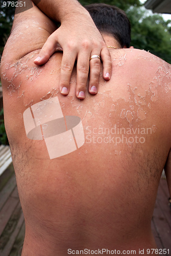 Image of Peeling Sunburned Back