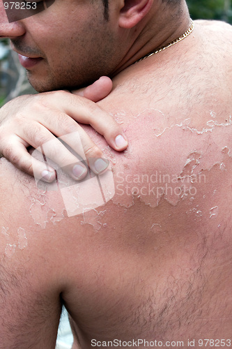 Image of Painful Peeling Sunburn