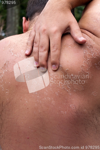 Image of Peeling Sunburned Back