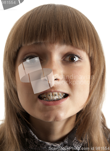 Image of Girl smiles with bracket on teeth