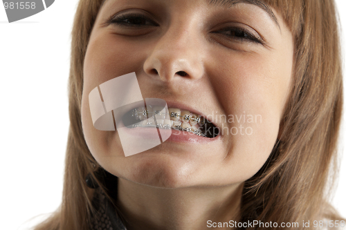 Image of Girl smiles with bracket on teeth