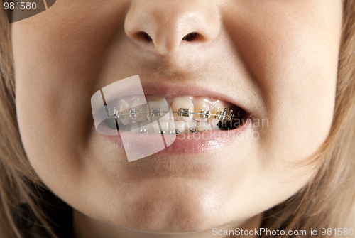 Image of Girl smiles with bracket on teeth