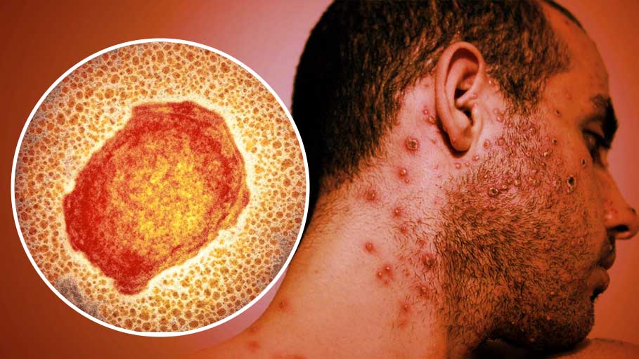France Confirms 51 Monkeypox Cases