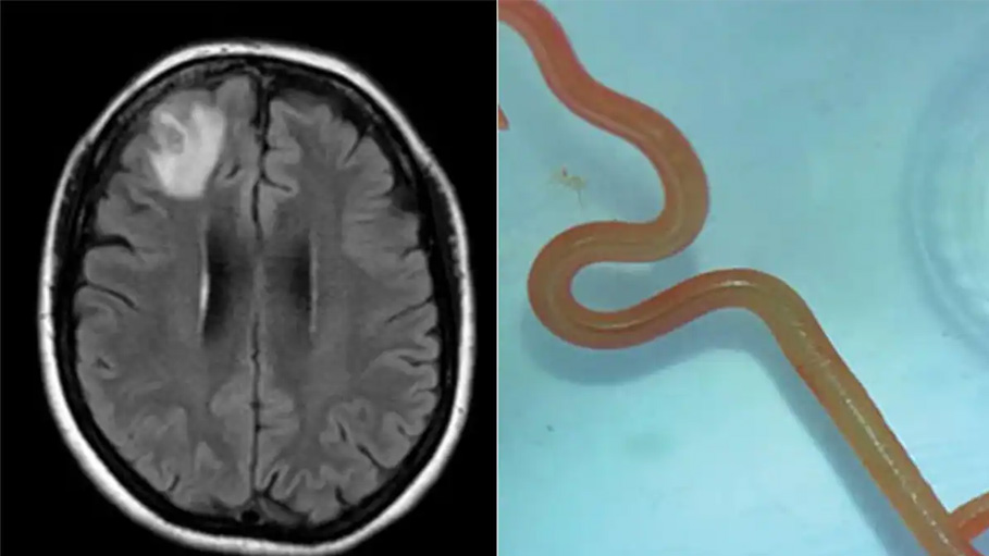 Worm Found in Australian Woman’s Brain Stuns Doctors ; World’s First Case in Medical History