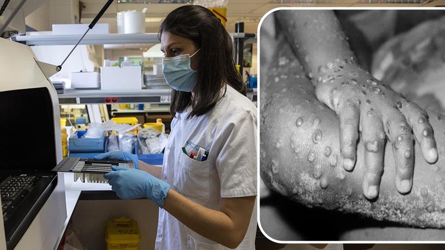 Monkeypox Symptoms Different to Prior Outbreaks: Study