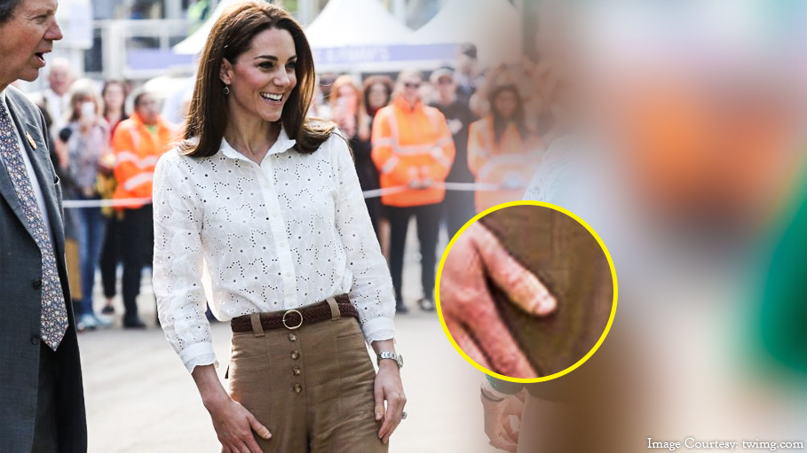 Why Does the Duchess of Cambridge Wear Plasters on Her Fingers?