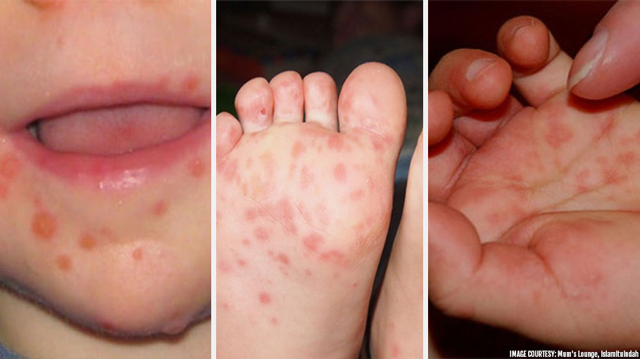 hand-foot-and-mouth-disease-a-viral-infection-that-causes-serious