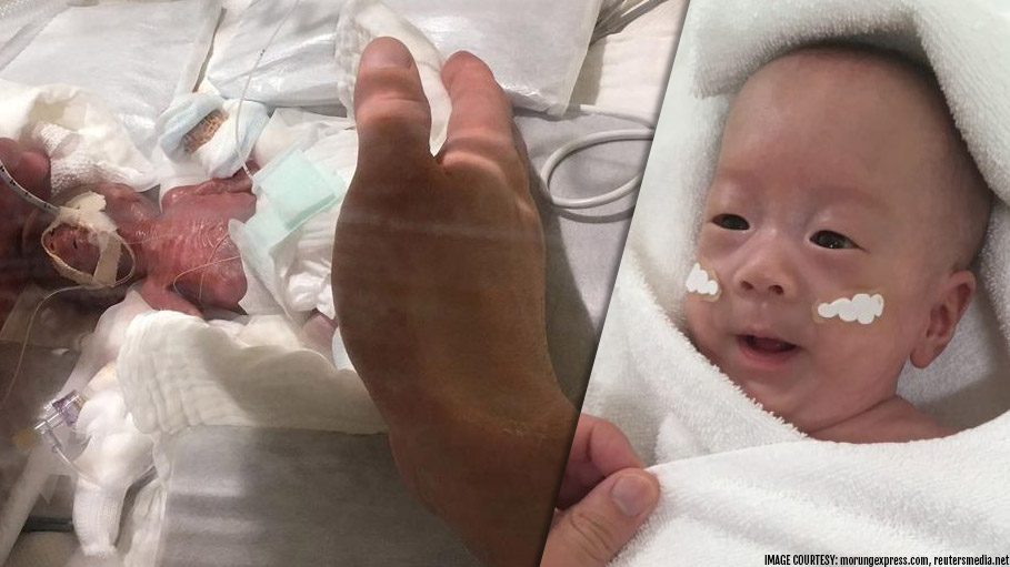 World’s Tiniest Baby Goes Home Healthy after Birth