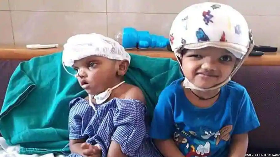 India's First Craniopagus Surgery: 1 of Odisha Twins Separated Dies