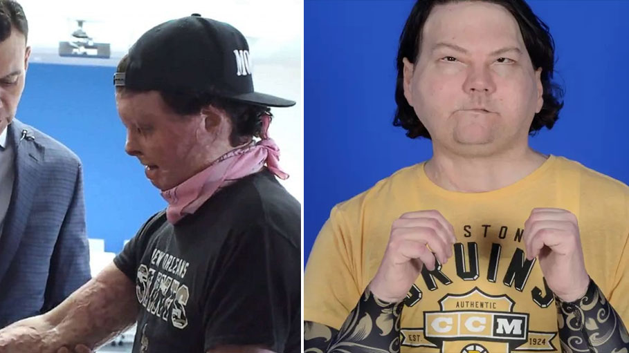 US Man with New Face, Hands Learns to Feel Life Anew