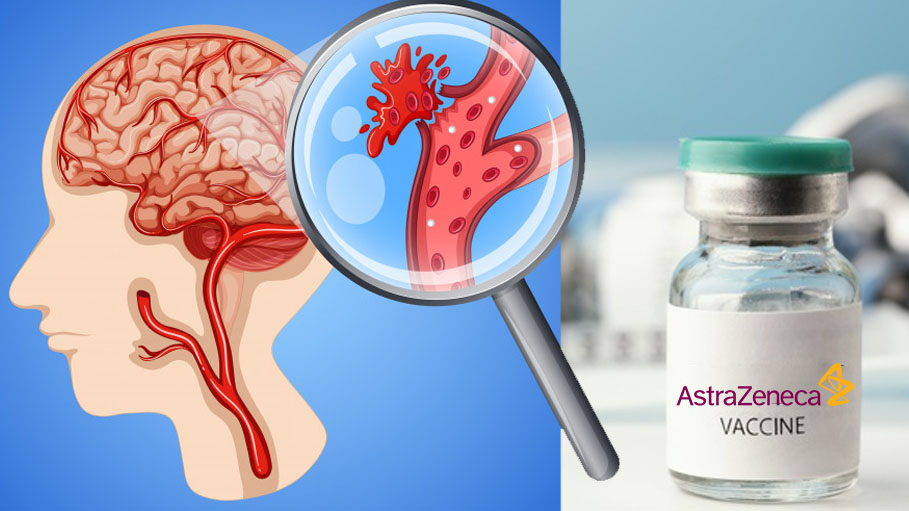 Clear Link Between AstraZeneca Vaccine, Rare Blood Clots in Brain