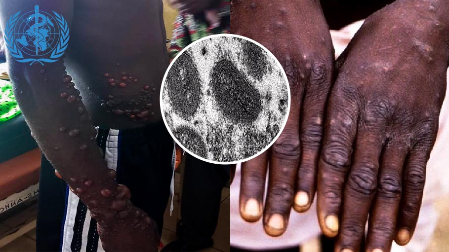 World Health Organisation: Unlikely Monkeypox Outbreak will Turn into a Global Pandemic