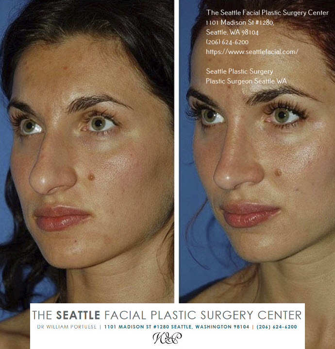 best rhinoplasty surgeon seattle