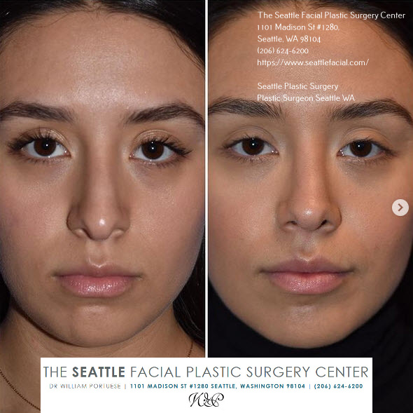 nose job under local anesthesia