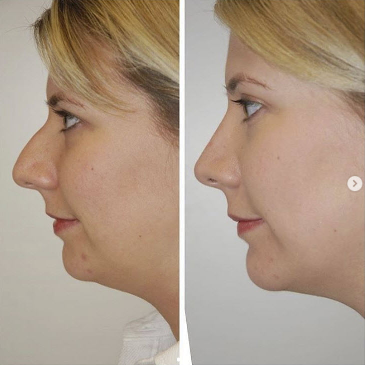 rhinoplasty surgeon