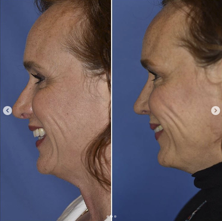 seattle rhinoplasty