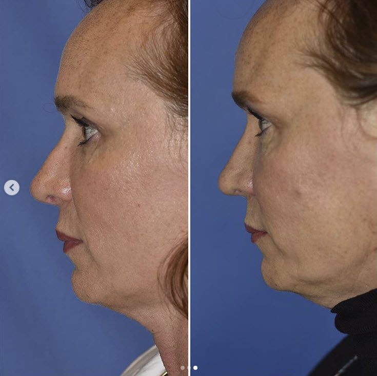 best rhinoplasty surgeon in washington