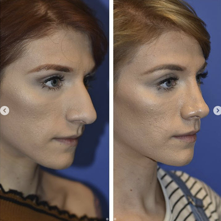 rhinoplasty seattle cost