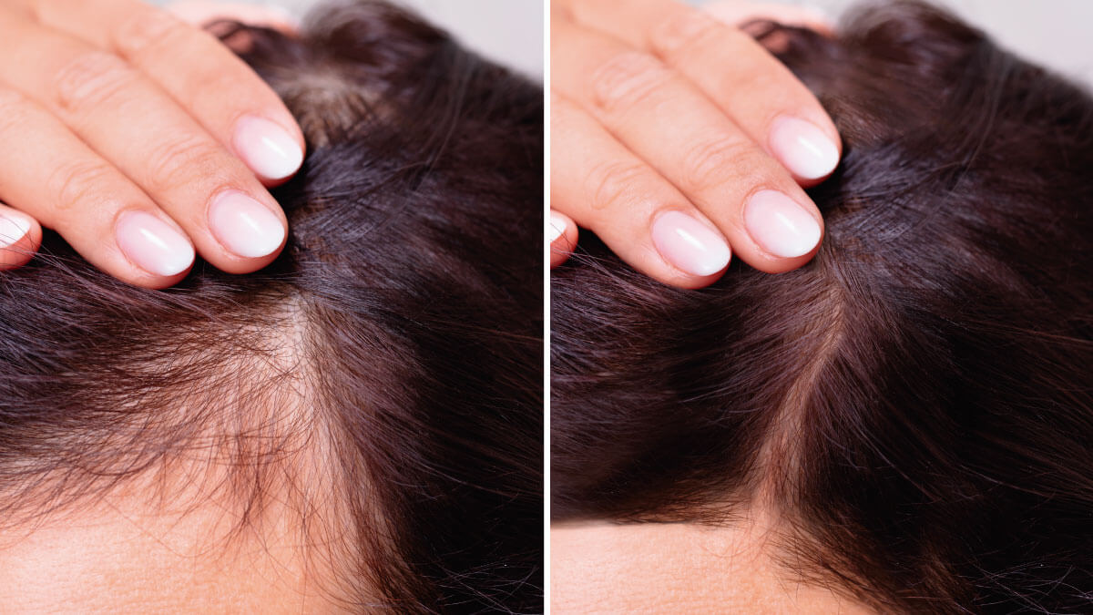 Tratamiento para la caída del cabello en mujeres